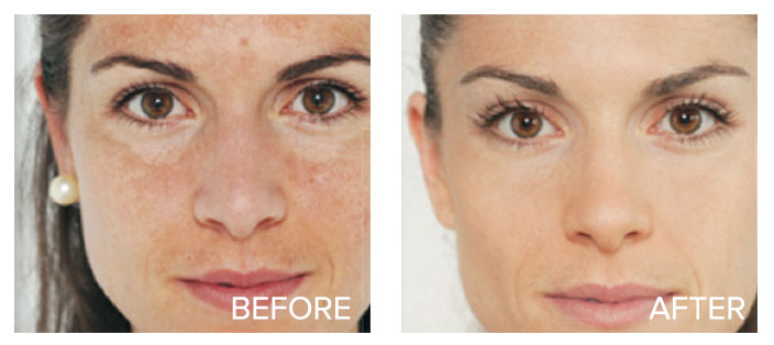 Acne Before Laser and Glyderm Treatment